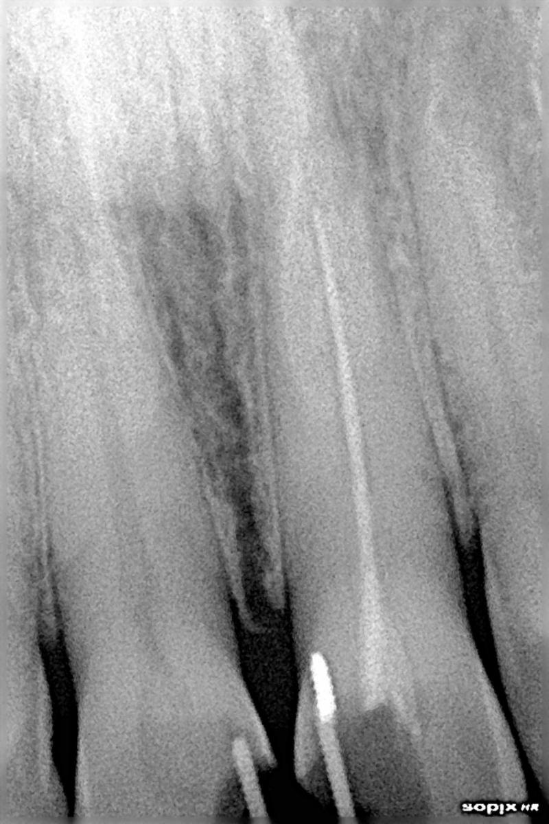 IMPROPER ROOT CANAL OBTURATION DONE BY GERMAN DENTIST LEADING TO FAILURE
