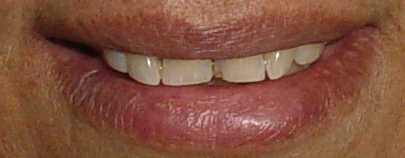 uneven & yellow teeth
