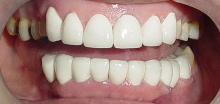 done hollywood smile designing & permanent teeth whitening