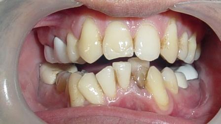 uneven yellow teeth