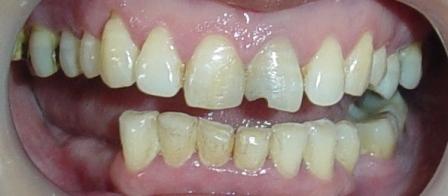 uneven & yellow teeth