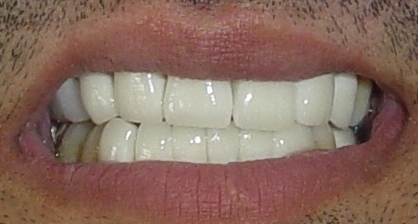 Done Hollywood Smile Designing & permanent teeth whitening