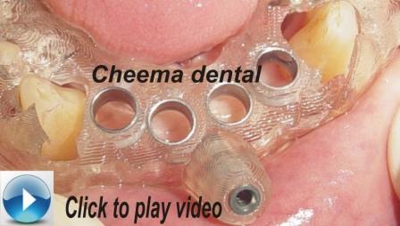 click to play video computer guided dental implants